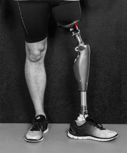 Osseointegration example